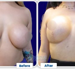 ba breastlift