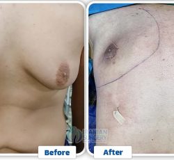 Gynecomastia in Iran