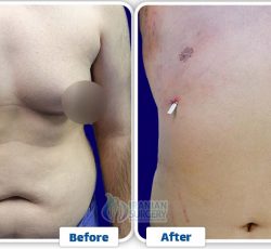 Gynecomastia in iran