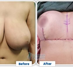 Breast Reduction In Iran