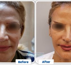 Facelift Surgery In Iran