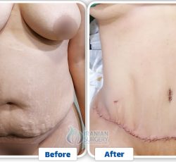 Liposuction in Iran