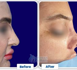 Rhinoplasty In Iran