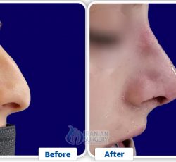 Rhinoplasty In Iran