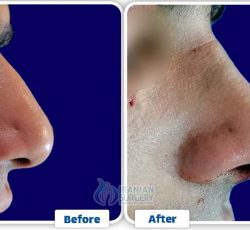 Rhinoplasty In Iran