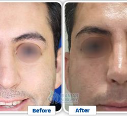 Revision Rhinoplasty in Iran