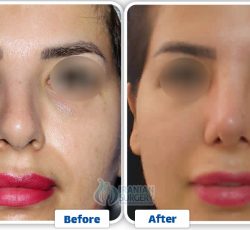 Revision Rhinoplasty in Iran