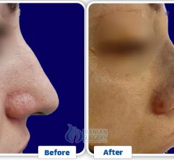 Revision Rhinoplasty in Iran