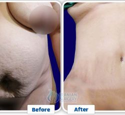 Tummy Tuck In Iran