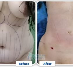 Vaser Liposuction In Iran