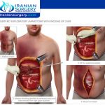 Laparotomy surgery in Iran