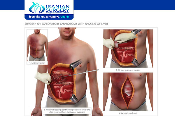 Laparotomy surgery in Iran