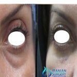 cost of blepharoplasty iran