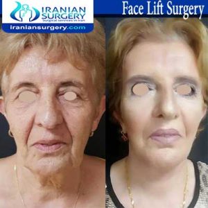 facelift surgery B&A
