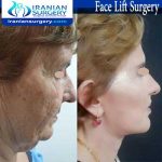 facelift surgery B&A 2