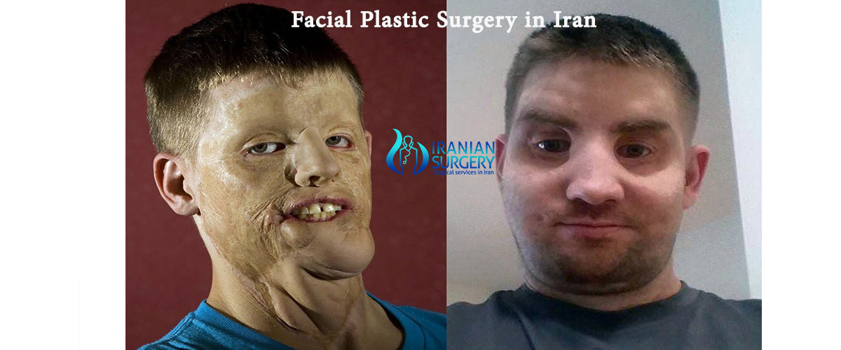 facial plastic surgery cost iran