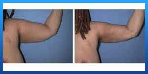Do lumps after arm liposuction go away?