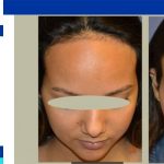 forehead reduction surgery procedure