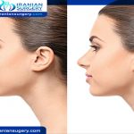 Rhinoplasty Cost in Iran