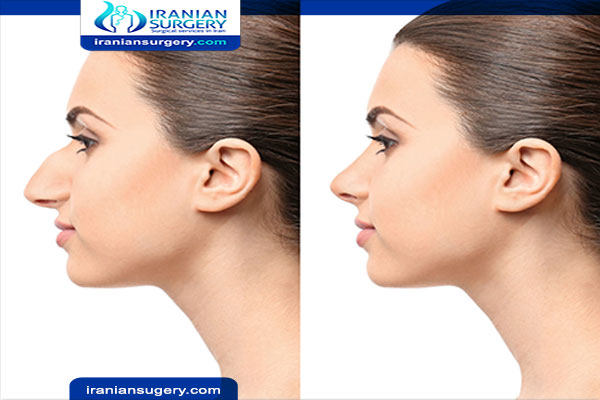 Rhinoplasty Cost in Iran