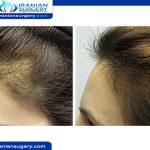 تجارب زراعة الشعر للنساء