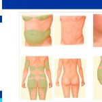 full body lipoduction cost
