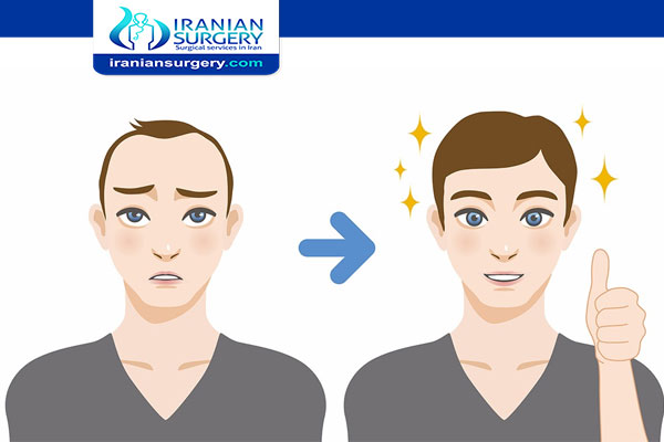 Long-term side effects of hair transplant surgery