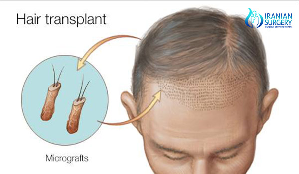 hair transplant in iran