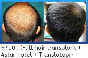 hair transplant in shiraz