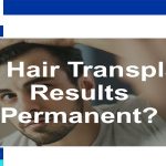 is hair transplant permanent
