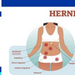 Hernia surgery complications