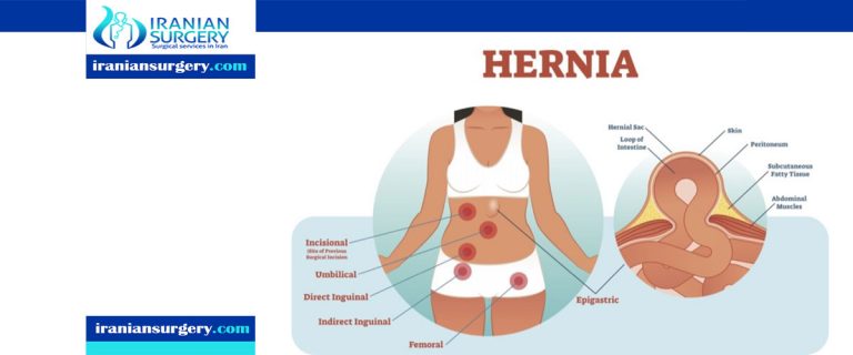Hernia surgery complications Iranian Surgery