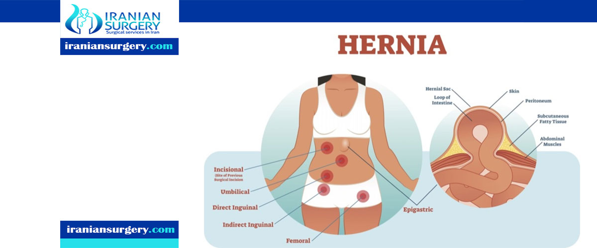 Hernia surgery complications