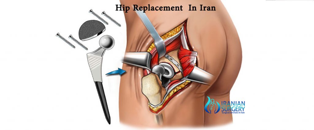 hip replacement cost in iran