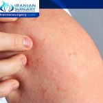 hives after bariatric surgery
