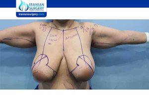 how long after breast reduction will i know my size?, Review