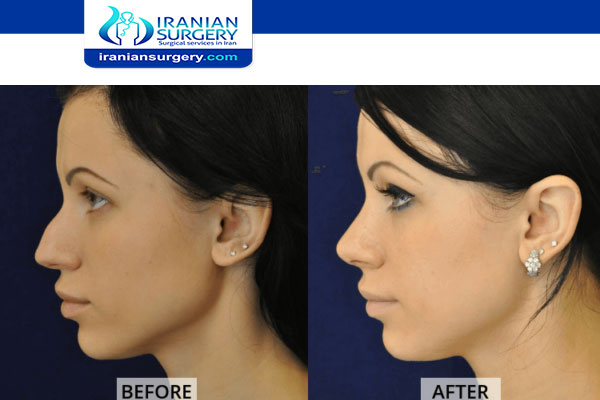 How To Fix A Deviated Septum Without Surgery Iranian Surgery