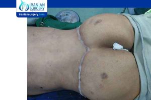 plastic surgery in Iran pictures