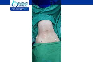 tummy tuck surgery in Iran