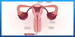 How many days after period is Frozen Embryo Transfer?