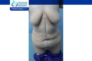 tummy tuck surgery in Iran