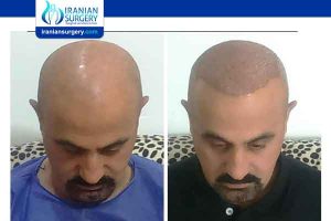 best hair transplant method