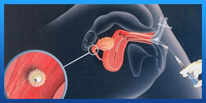 iui vs ivf