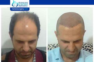 hair transplant in iran