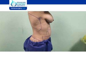 tummy tuck in Iran