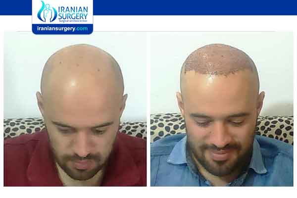 Hair transplant in iran review 2 - Iranian Surgery