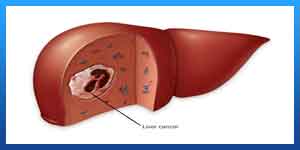 سرطان الکبد