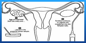 ZIFT Procedure Advantages and Disadvantages