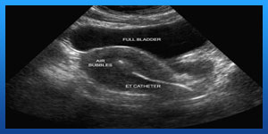 How many days after period is frozen embryo transfer?