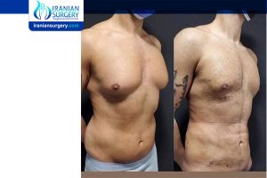 gynecomastia surgery cost in iran